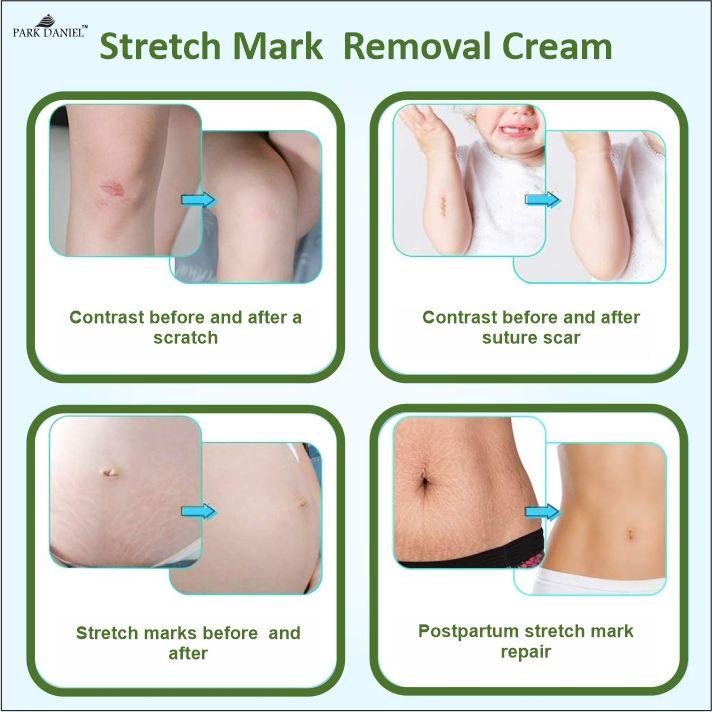 Park Daniel Stretch Marks Removal During Pregancy | Weight Loss Skin Toining Pack of 4 of (100 grams)