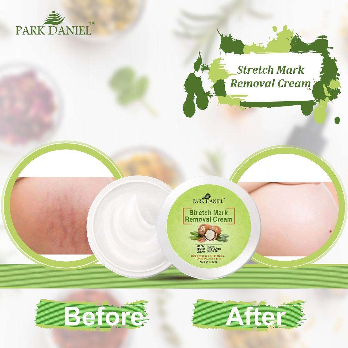 Park Daniel Stretch Marks Removal During Pregancy | Weight Loss Skin Toining Pack of 4 of (100 grams)